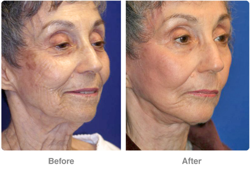 Resulta ng larawan para sa Rhytidectomy, surgical removal of wrinkles